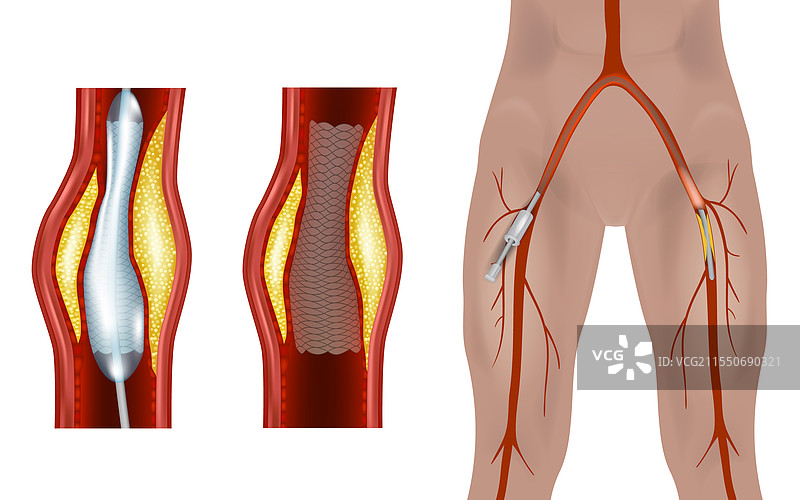 股动脉内血管手术成形术图片素材
