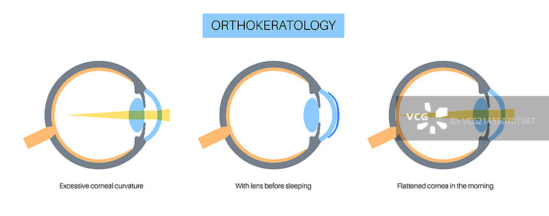 正视角接触镜图片素材