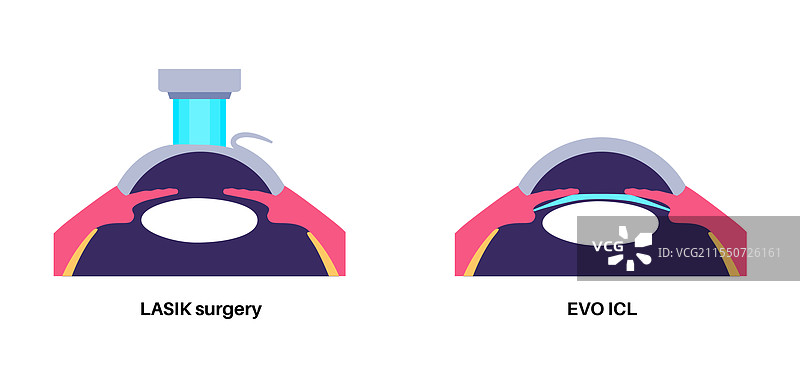 LASIK和ICL EVO图片素材