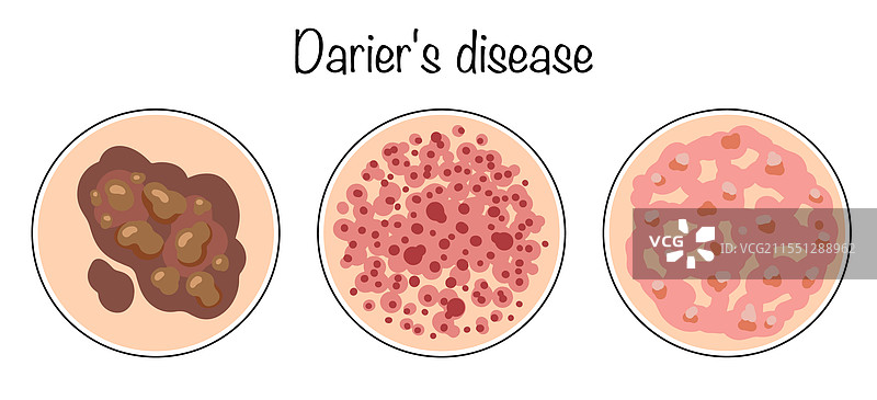 达里埃病图片素材