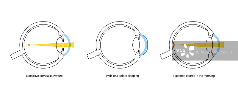 正视角接触镜图片素材