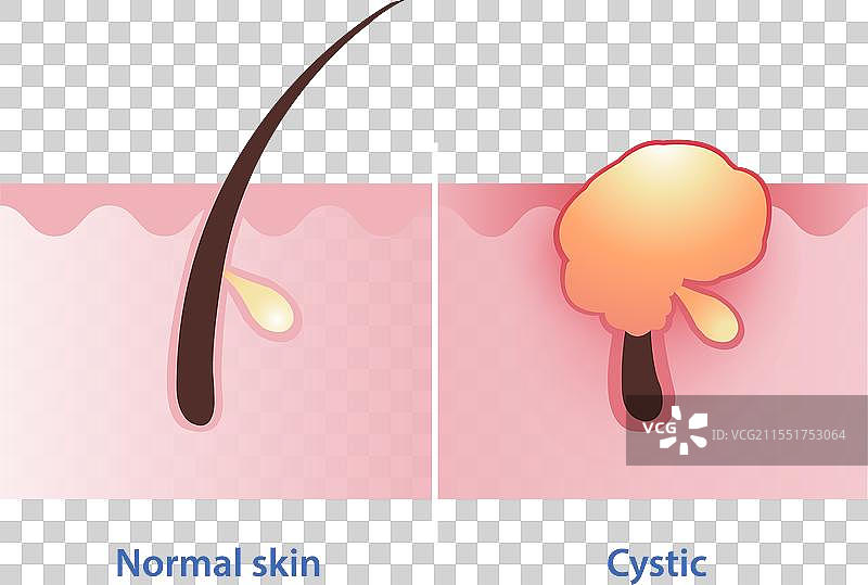 囊性痤疮是最严重的炎症类型图片素材