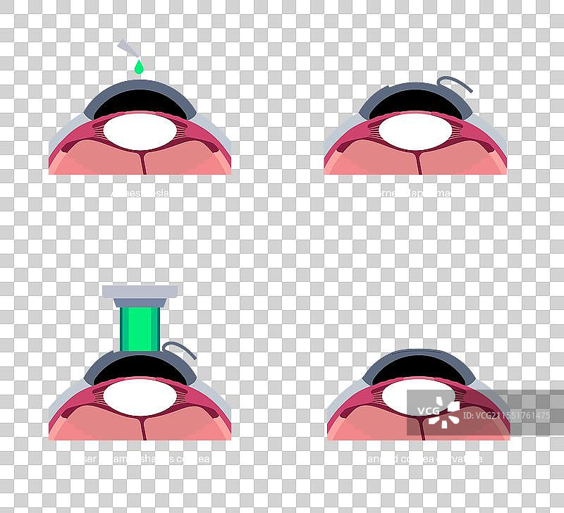 激光矫正视力手术图片素材