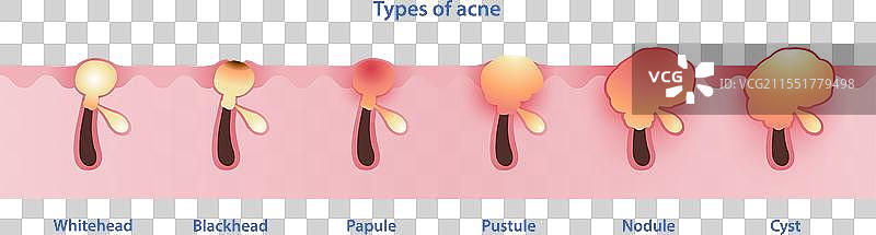 白色背景上的痤疮类型图片素材