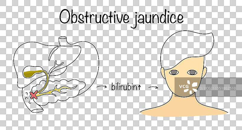 梗阻性黄疸图片素材
