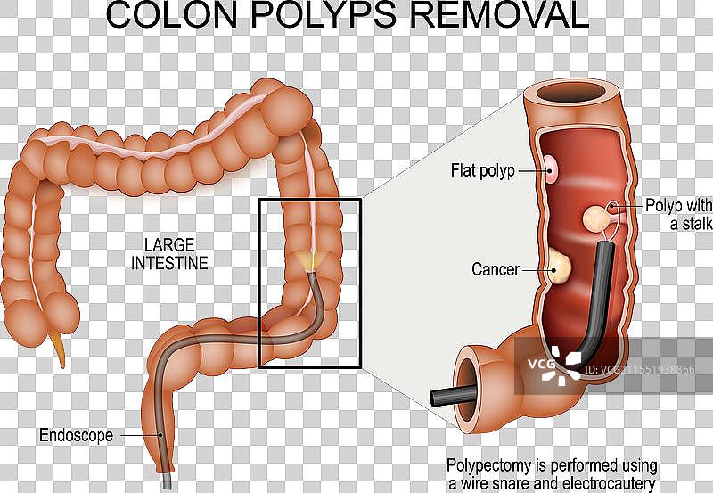 结肠息肉切除，结肠镜检查和息肉切除术图片素材