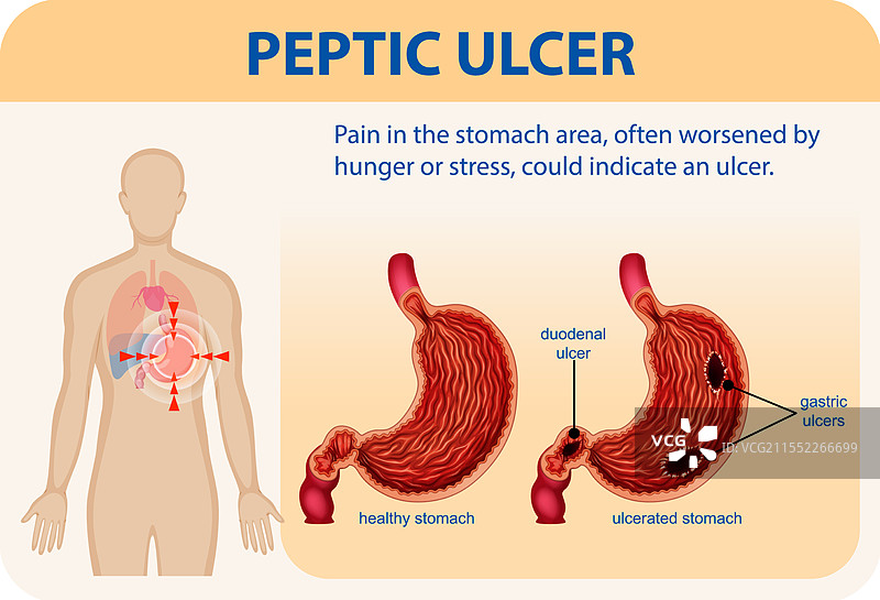 胃溃疡及相关症状图片素材