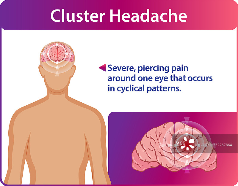 丛集性头痛的疼痛及其对大脑的影响图片素材