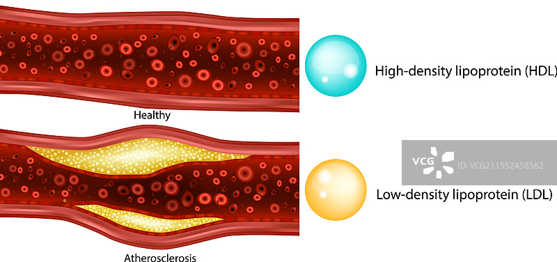 低密度脂蛋白胆固醇LDL和高密度脂蛋白胆固醇图片素材