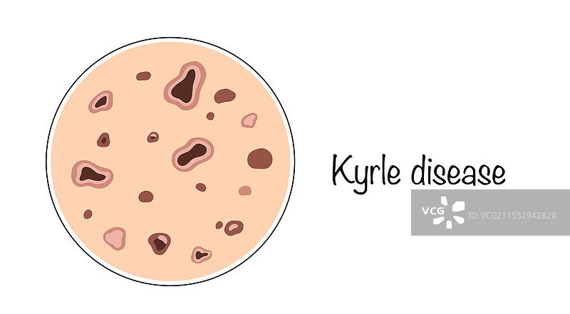 凯尔病图片素材