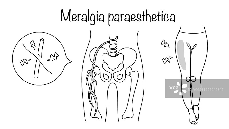 股外侧神经痛图片素材