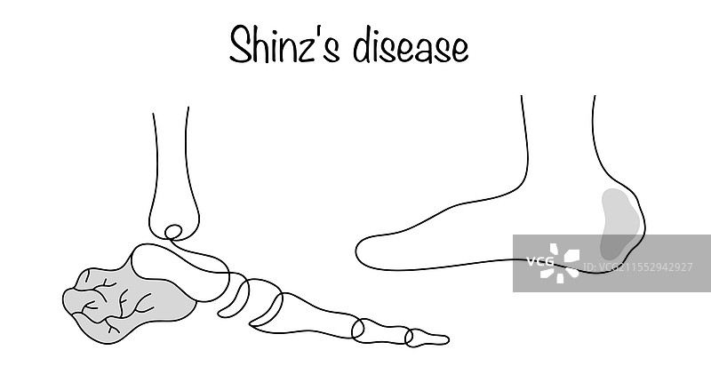 辛兹39病图片素材