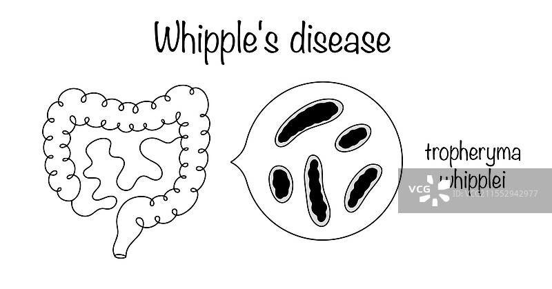 威普尔病图片素材