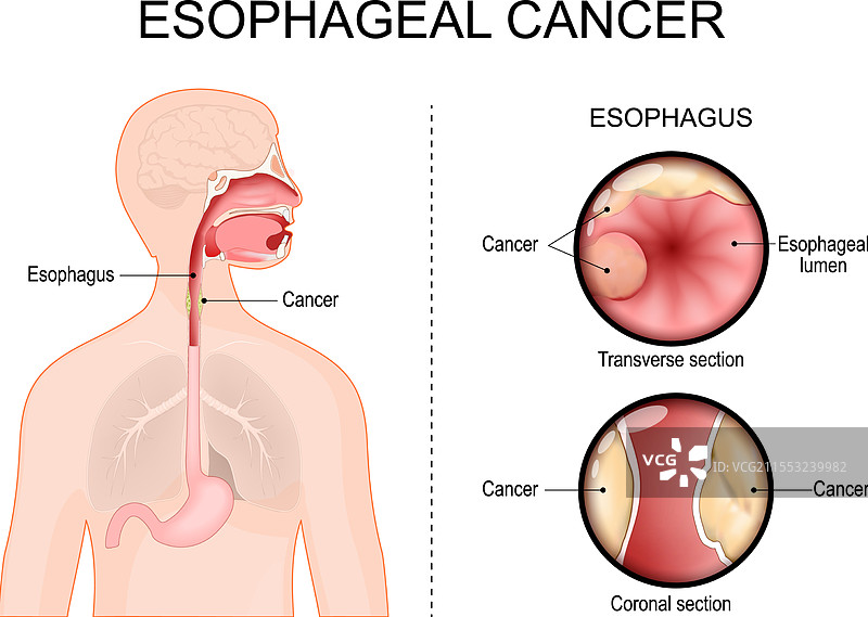 食管癌腺癌图片素材