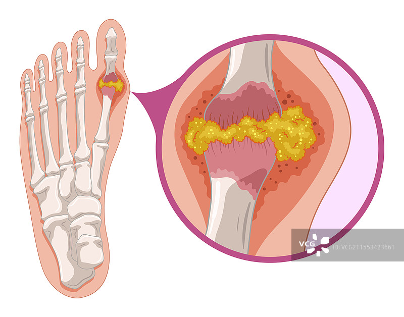 人脚的痛风图解，显示结晶化过程图片素材