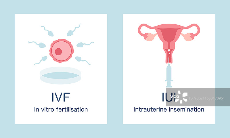 体外受精（IVF）和宫内受精图片素材