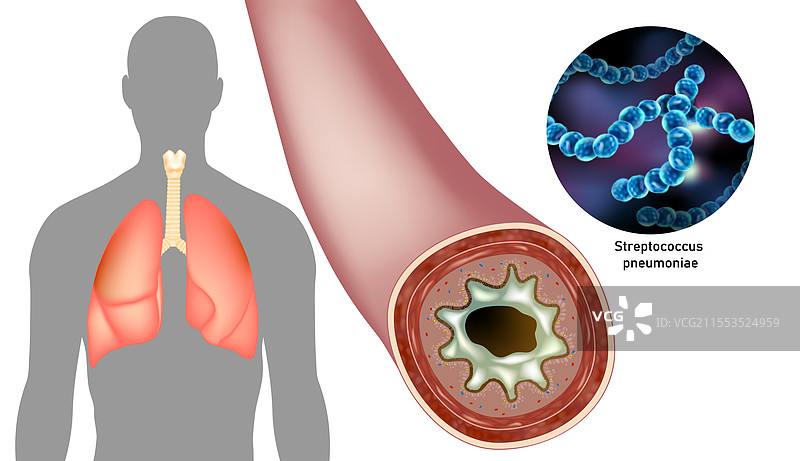 肺炎球菌与人类呼吸系统图片素材