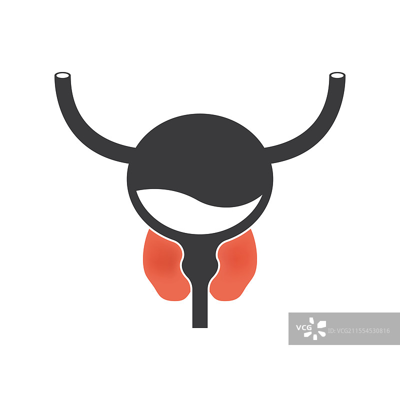 前列腺炎：前列腺的肿胀和炎症图片素材