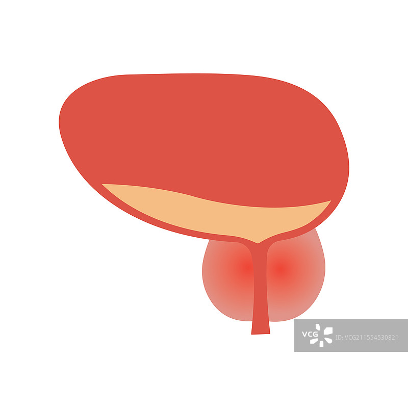 前列腺炎：前列腺的肿胀和炎症图片素材