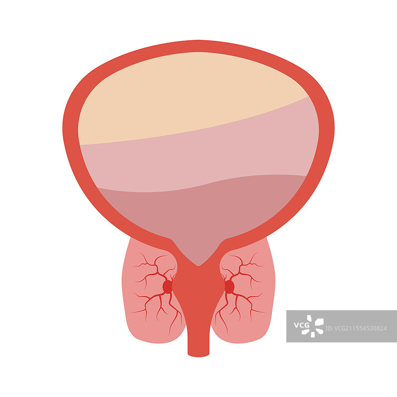 前列腺炎：前列腺的肿胀和炎症图片素材