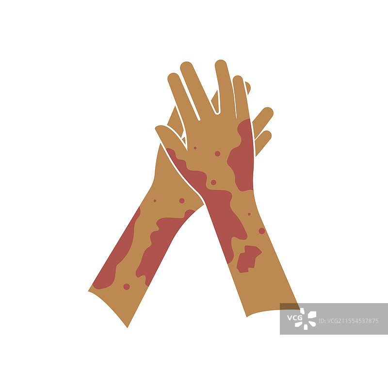 皮肤 rash 昆虫叮咬 过敏反应图片素材