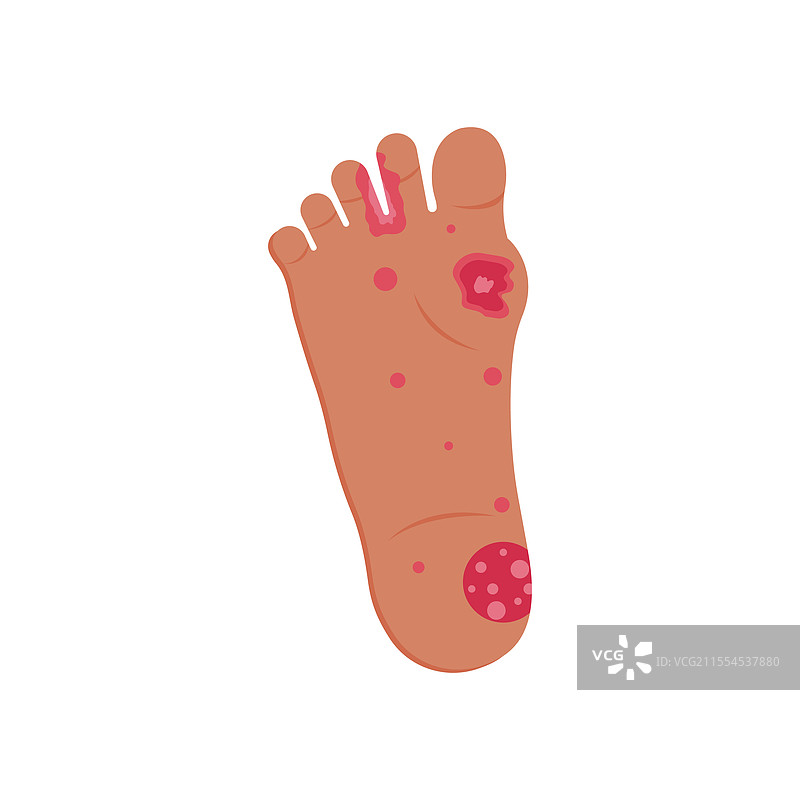 皮肤 rash 昆虫叮咬 过敏反应图片素材