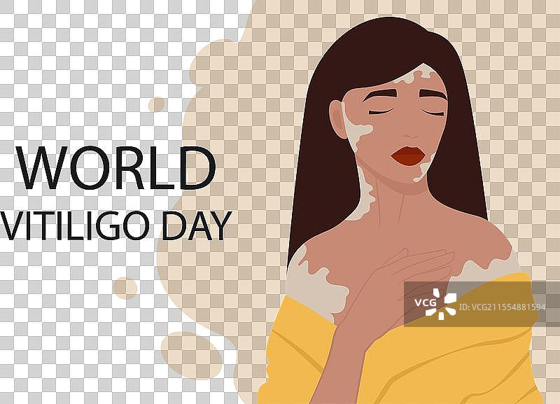 年轻的白人女孩，患有白癜风图片素材