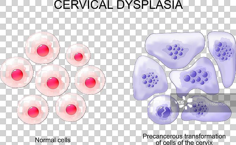 宫颈发育不良 宫颈癌图片素材