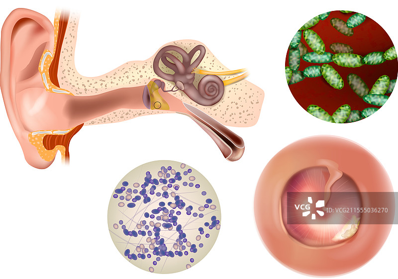 中耳的解剖与急性感染图片素材