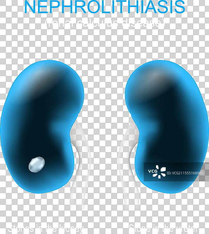 肾结石病图片素材