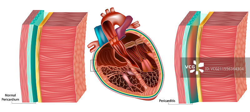心包炎与正常心包医学图片素材