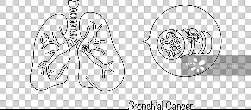 支气管癌图片素材