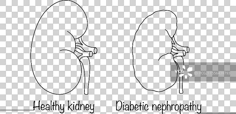 糖尿病肾病图片素材