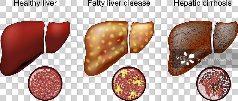 脂肪肝病 肝硬化图片素材