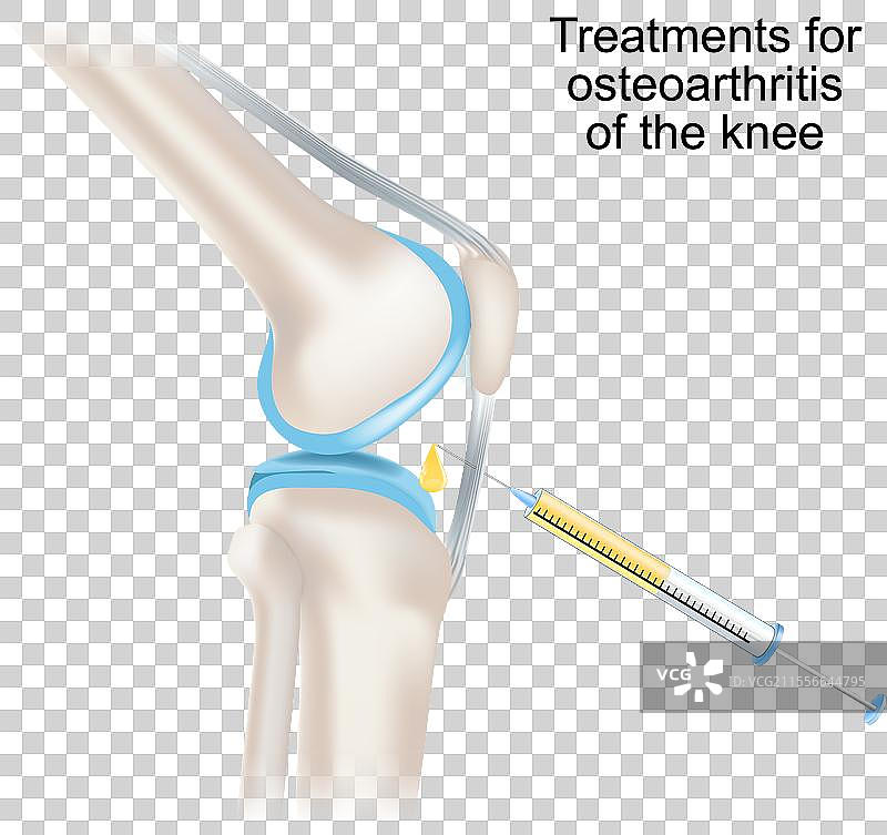 膝关节骨关节炎的治疗方法图片素材
