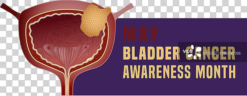 尿路上皮癌景观海报图片素材