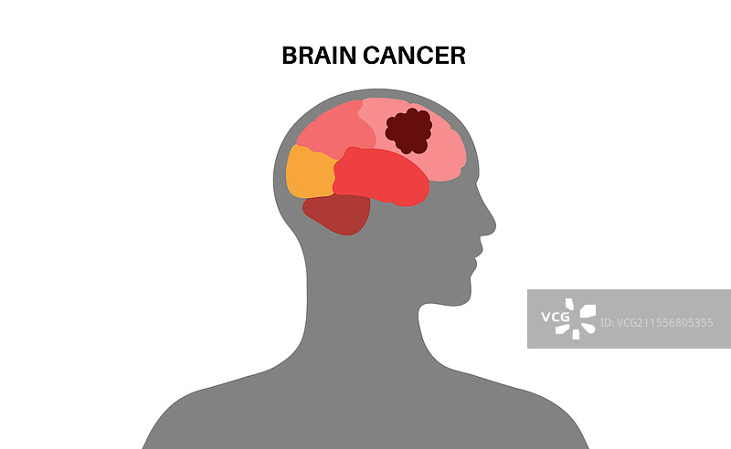 脑癌海报图片素材
