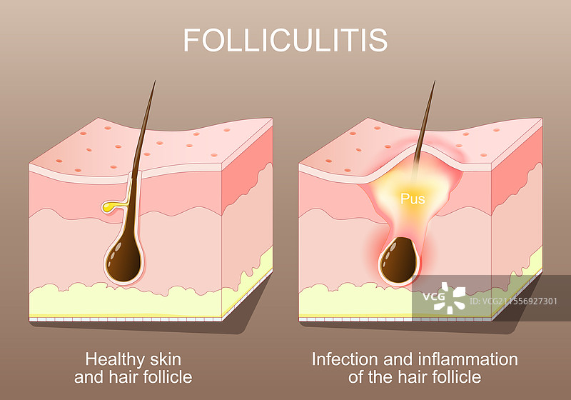 毛囊炎健康皮肤的前后对比图片素材