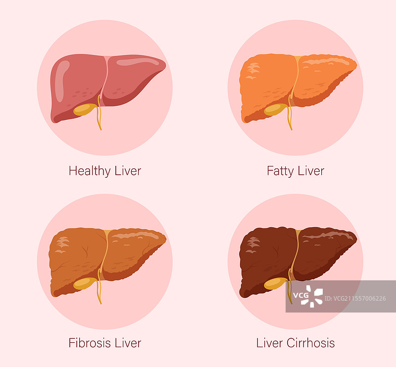 肝脏健康阶段图片素材