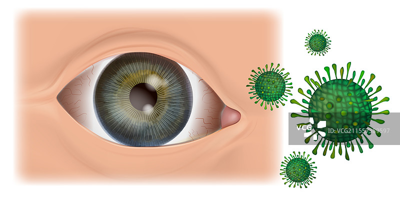 病毒性结膜炎医学眼睛图片素材