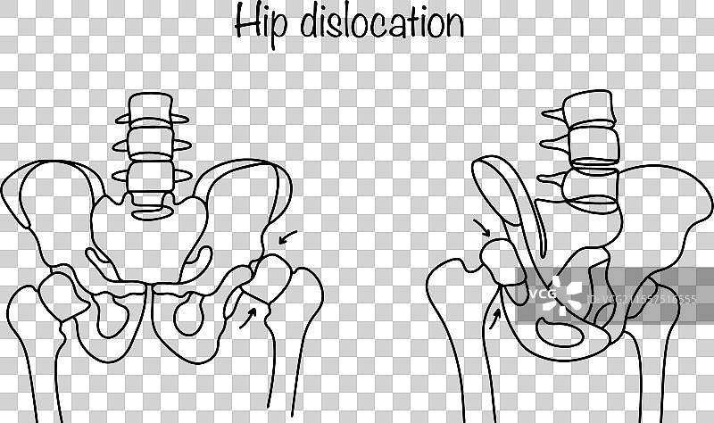 髋关节脱位图片素材