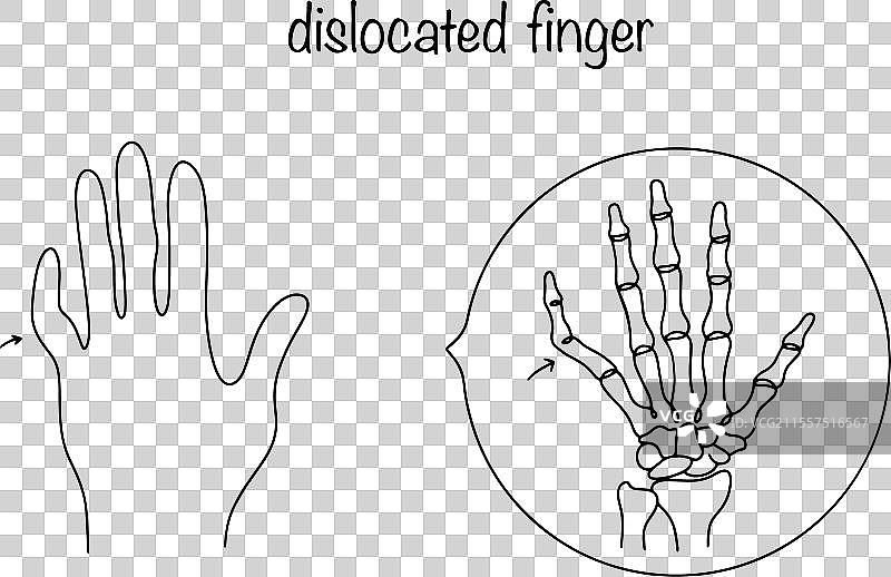 脱臼的小手指图片素材