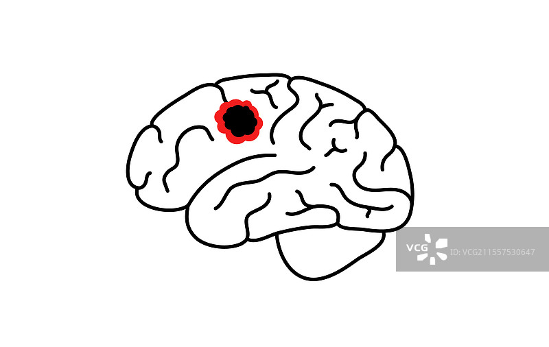 脑癌海报图片素材