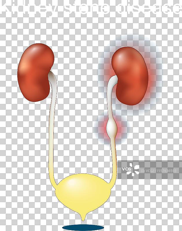 肾结石疾病图片素材