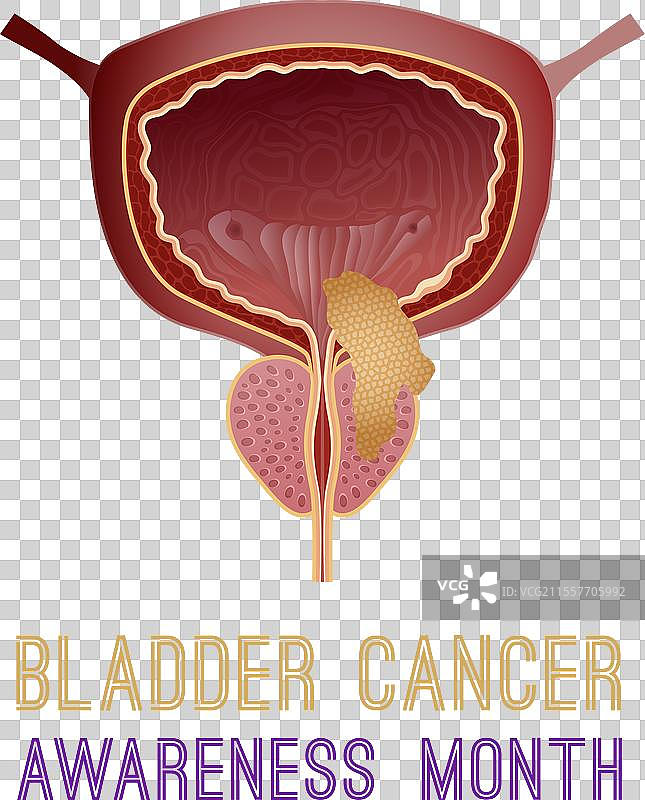 尿路上皮癌肖像海报图片素材