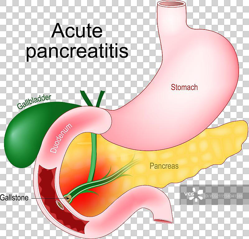 急性胰腺炎 胰腺炎症图片素材