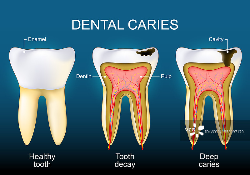 牙齿龋齿 健康牙齿 龋齿和深度图片素材