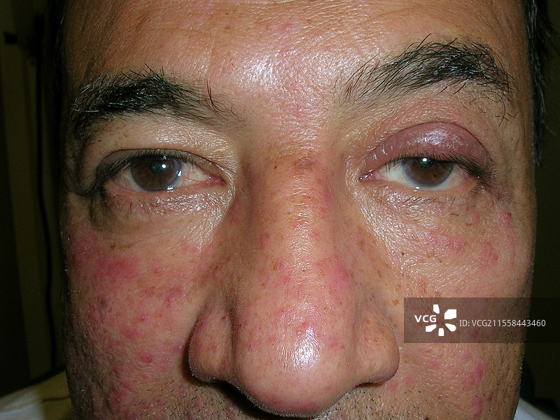 眼睑玫瑰痤疮和麦粒肿图片素材