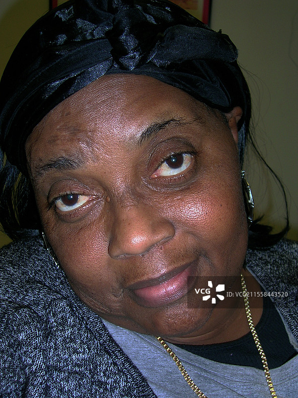 用英夫利西单抗治疗的肉芽肿病图片素材