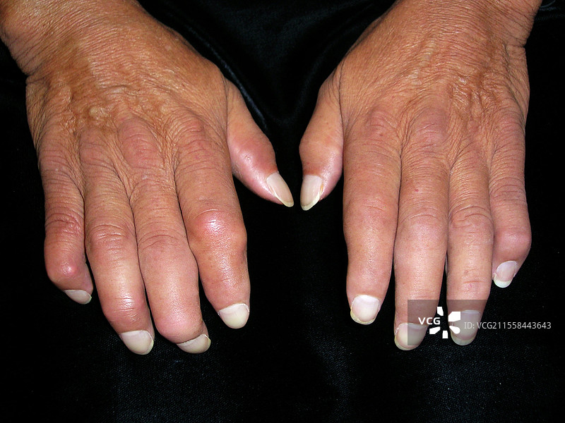 硬皮病图片素材